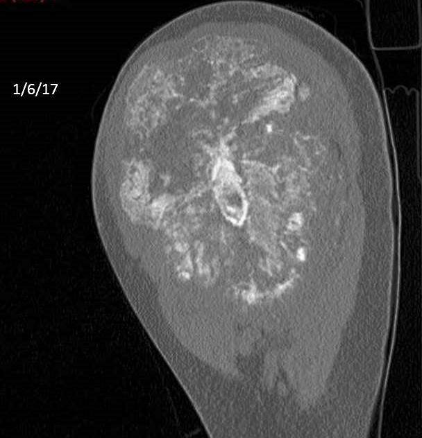 Figure 5 for case Osteosarcoma ( RID4010 ) with a pathologic fracture